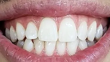 After Treatment Photo