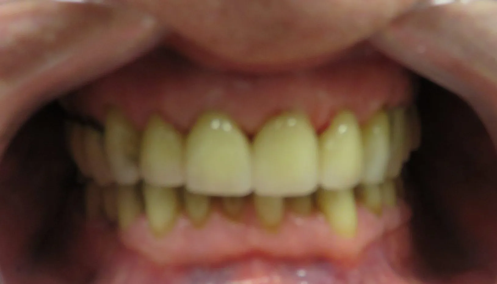 Up close photo of after Porcelain Crowns
