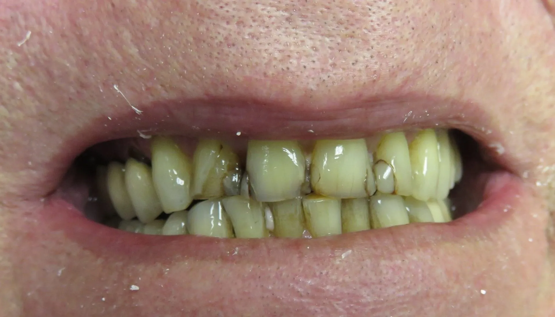 Up close photo of before Porcelain Crowns